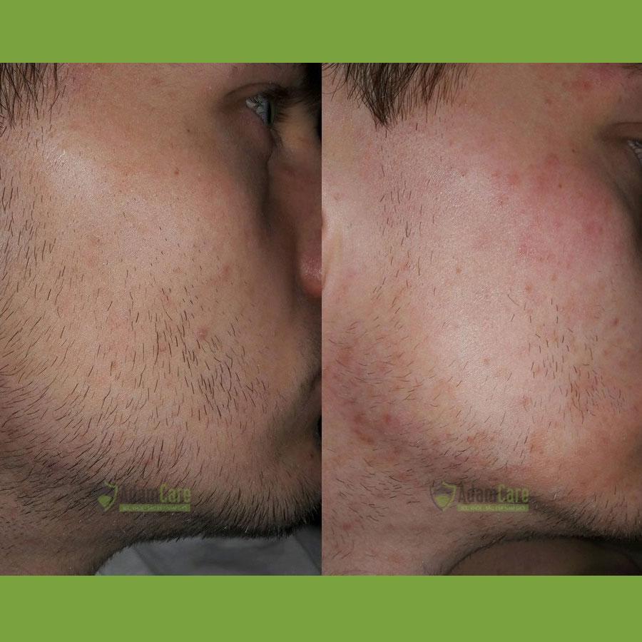 [HCM]Bột Retinol pha Minoxidil
