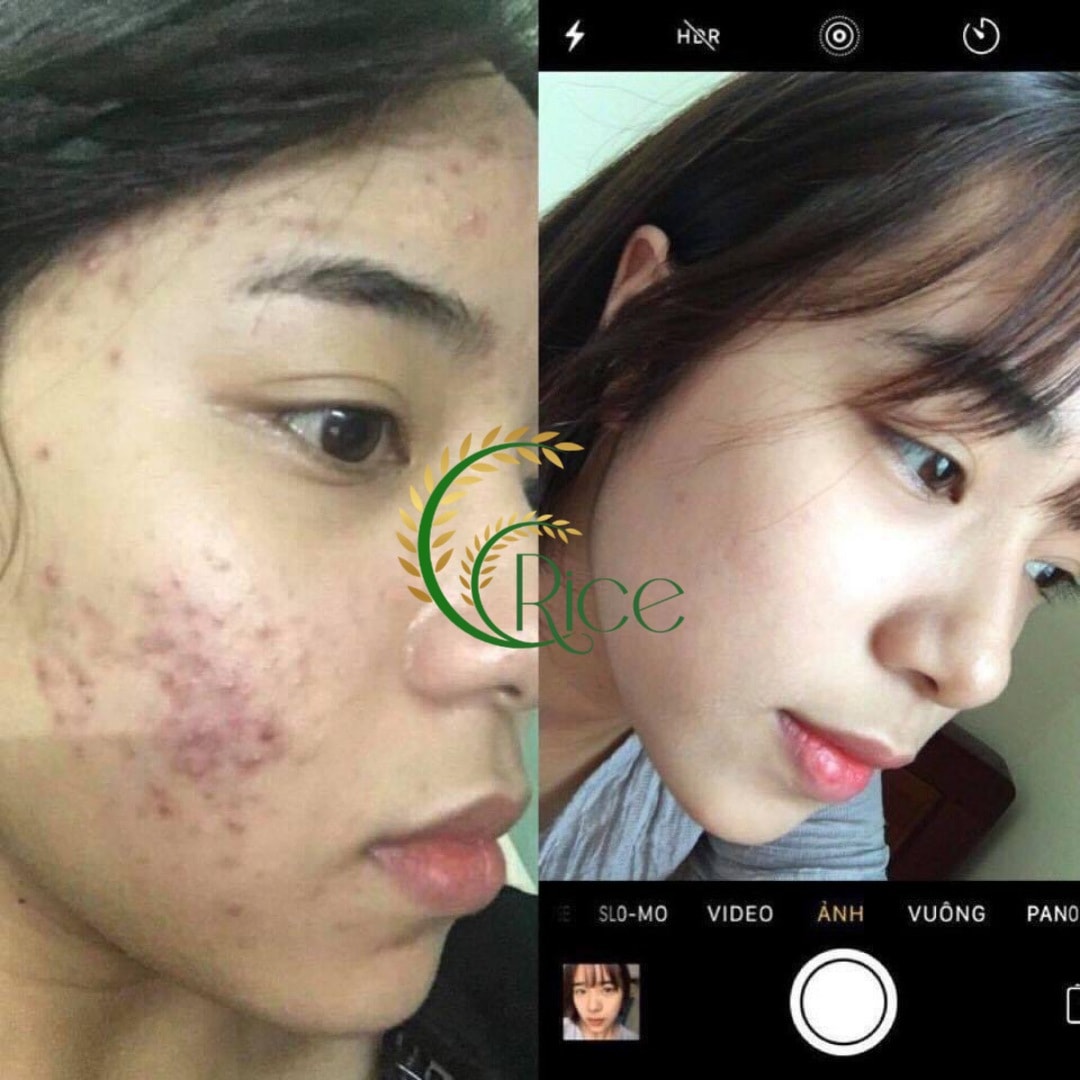 [KÈM QUÀ TẶNG] SERUM RICE MẦM GẠO NON XÓA MỤN MỜ THÂM NÁM SẠM DA