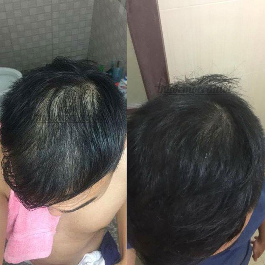 [HCM]Minoxidil 5% mọc Râu Tóc Mỹ hãng Kirkland tặng bột LCLT
