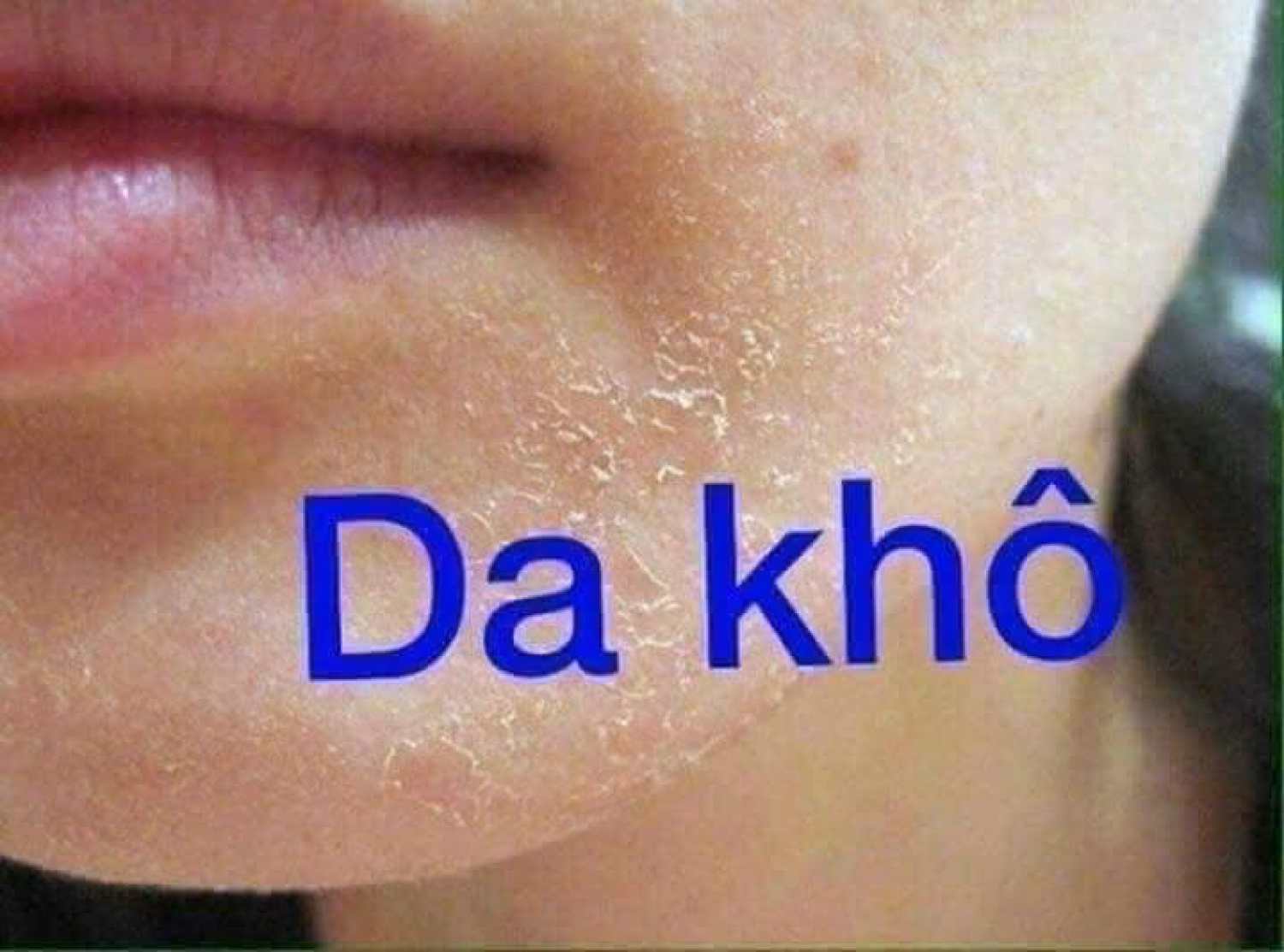 Kem nẻ Vaseline 100g Viện Bỏng - KNE