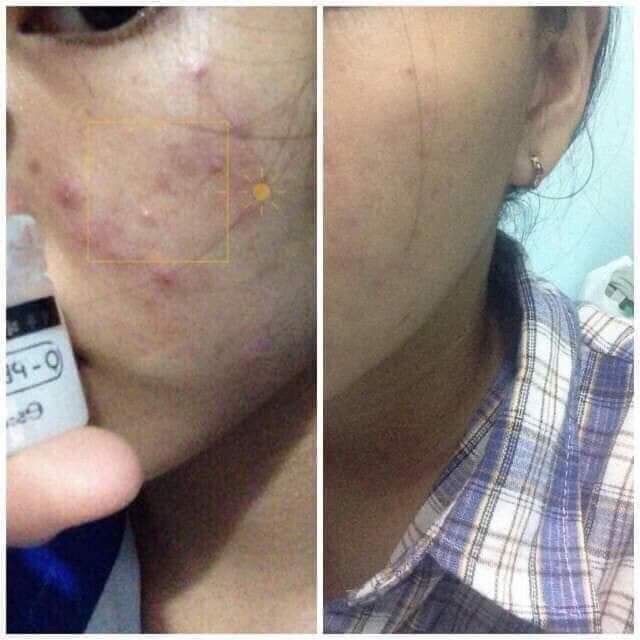 Serum Tri Thâm Jiuhe