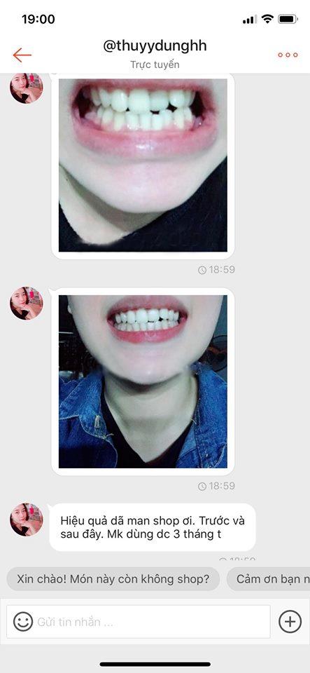 [HCM]DỤNG CỤ NIỀNG RĂNG TẠI NHÀ - HÀM [ A1+A2+A3]