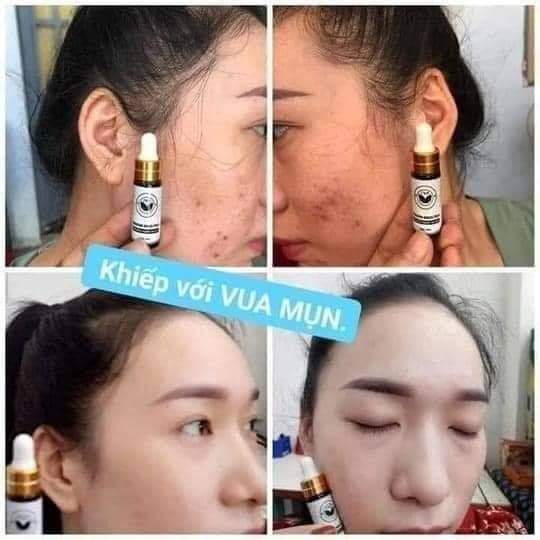Serum Mụn Trần Kim Huyền