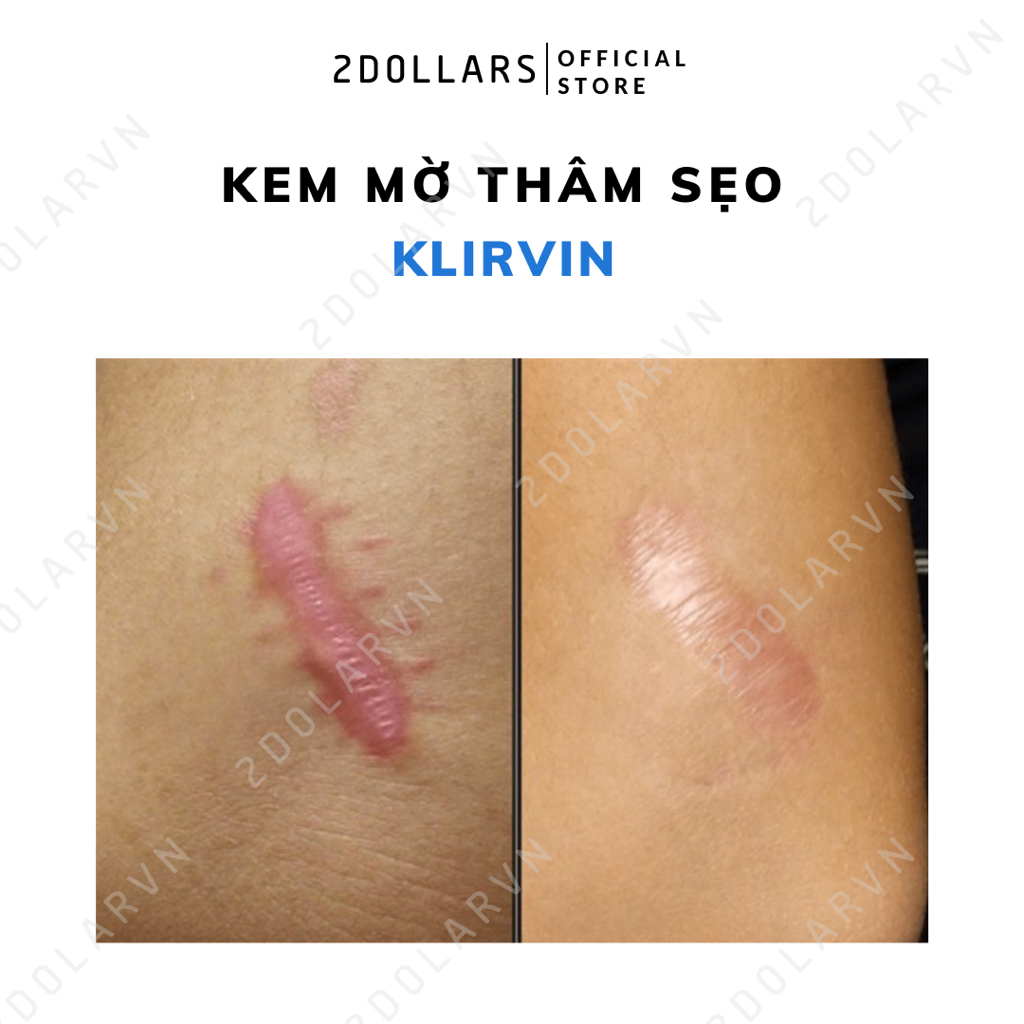 Kem Mờ Thâm Sẹo Klirvin Nga