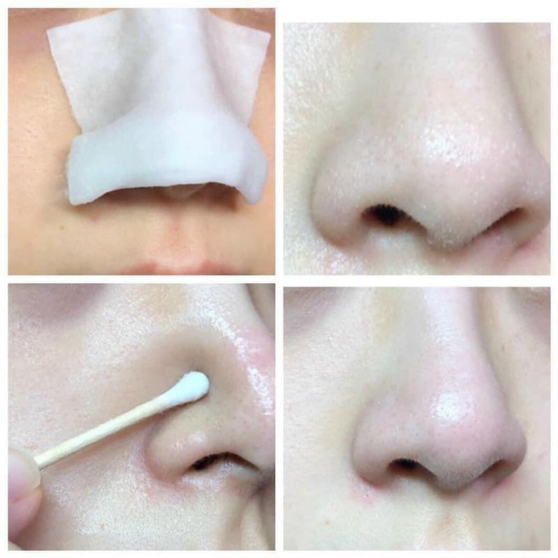 [Chính Hãng] Dung Dịch Ủ Mụn Đầu Đen Medi-peel Extra Super 9 Hàn Quốc