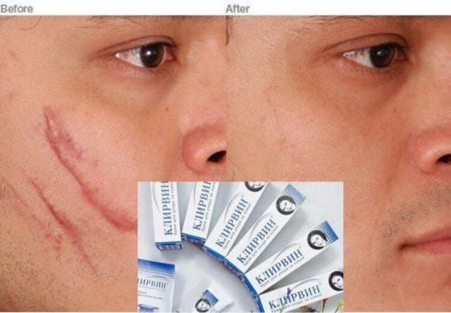 Kem mờ sẹo lồi lõm sẹo thâm Klirvin Nga