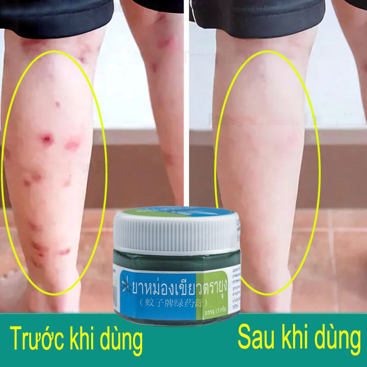 Dầu bôi vết muỗi đốt，Dầu bôi giảm muỗi đốt，Mosquito Balm Thái Lan .Chống muỗi đốt ,giảm ngứa da,ngừa vết bỏng,say tàu xe.unisex.