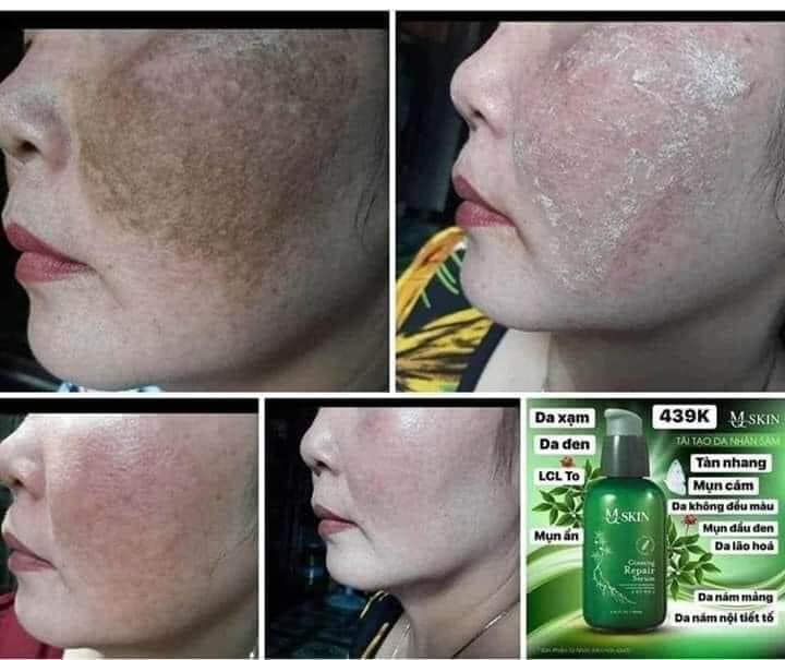 Serum Thay Da nhân sâm MQ skin