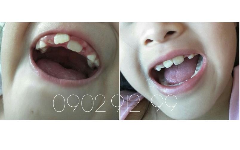 Bộ Niềng Răng Tại Nhà - Orthodontic Alignment Trainer Kit