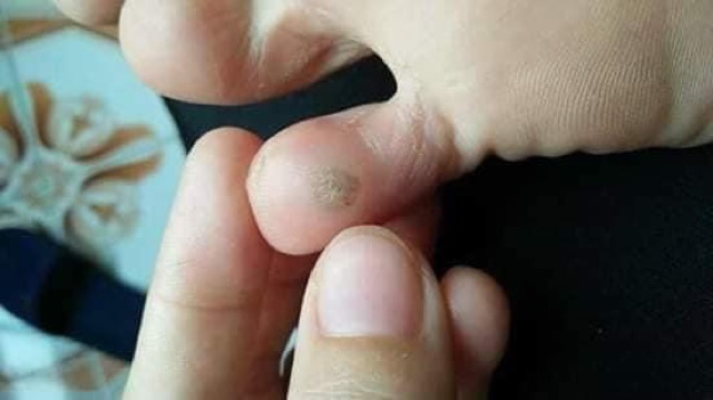Tinh Chất Bôi Mụn Cóc Ibokorori Nhật Bản