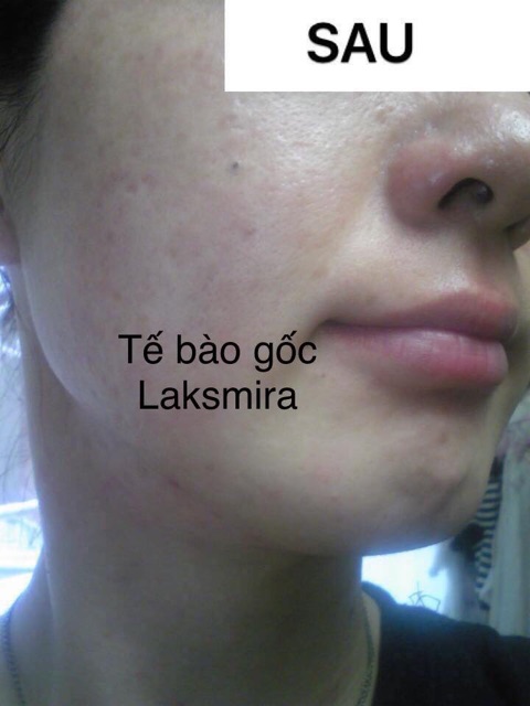 Tế bào gốc Laksmira Stem Cell Solution Hàn Quốc[ TÁCH LẺ ] 1 Ống