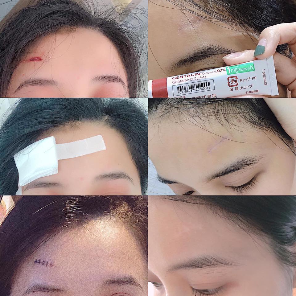 [HCM]Gel trị Sẹo Gentacin Nhật Tuýp 10g