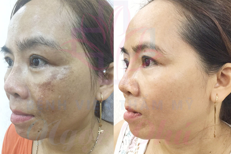 Serum nám Hoa Anh Đào 30ml