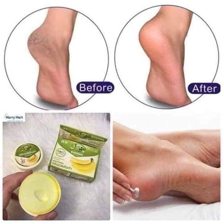 [HCM]Kem  Nứt Gót Chân Chuối