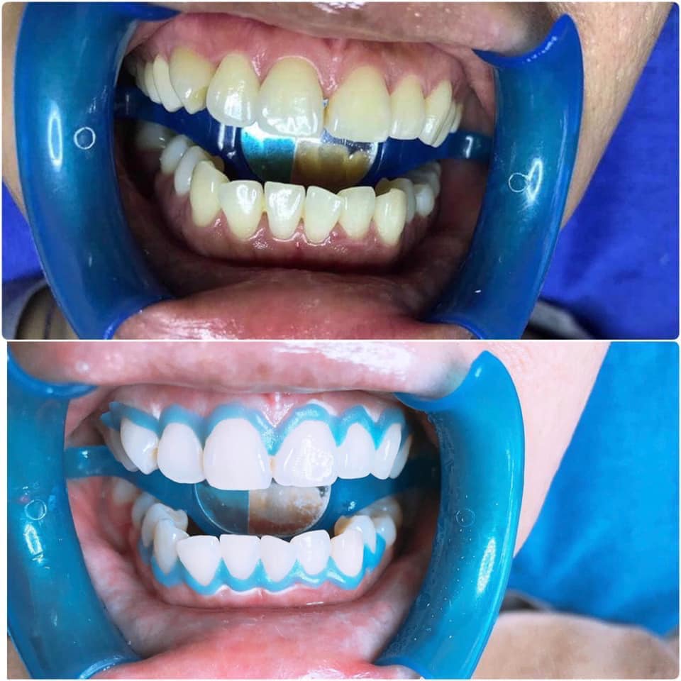 thuốc tẩy trắng răng pha sẵn (bật tông sau 30p)