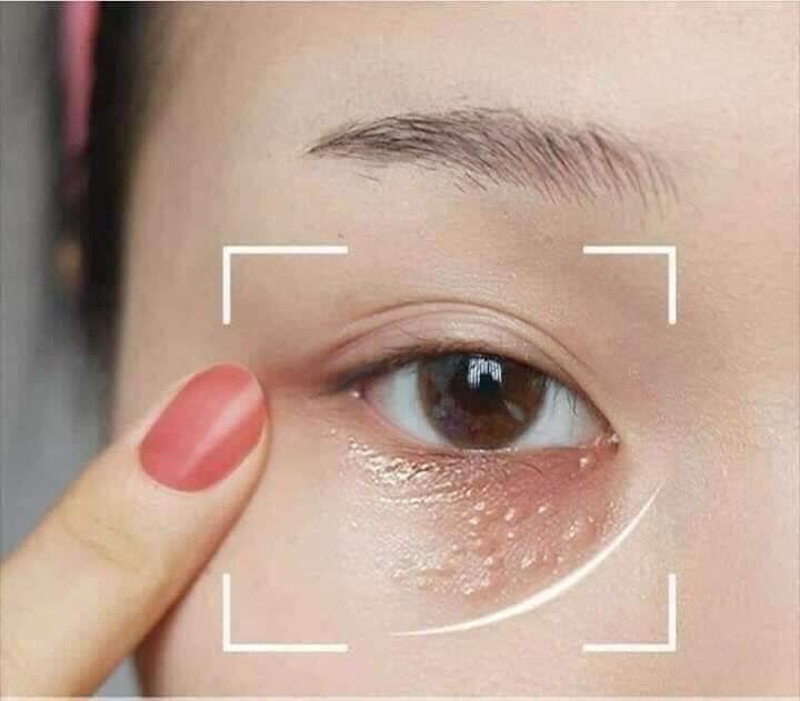 Kem trị mụn thịt Tsubuporon của Nhật