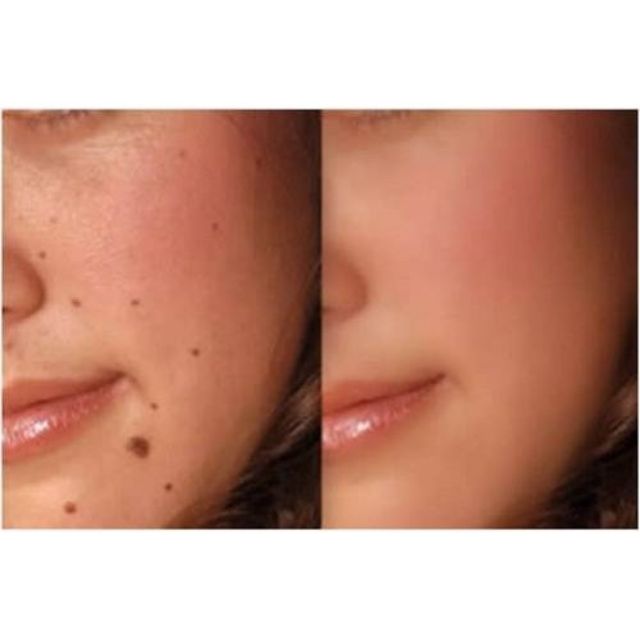 Gel chấm nốt ruồi tàn nhang