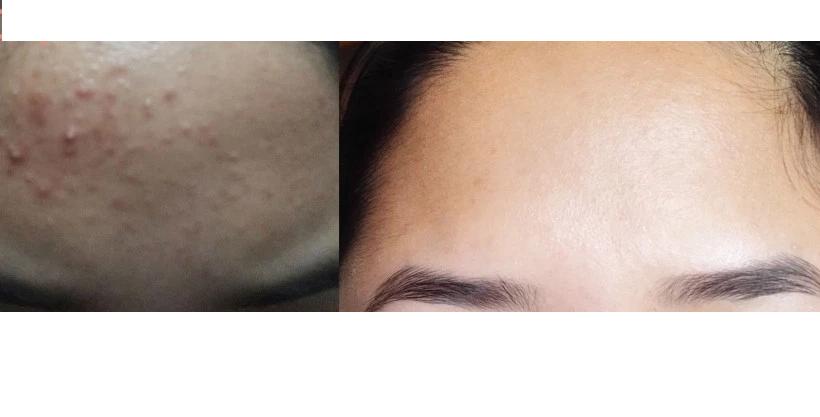 KEM HỖ TRỢ TRỊ MỤN TRỨNG CÁ.TEEN DERM ALPHA PURE 30ML.( THAY THẾ TEENDERM K 30ML)