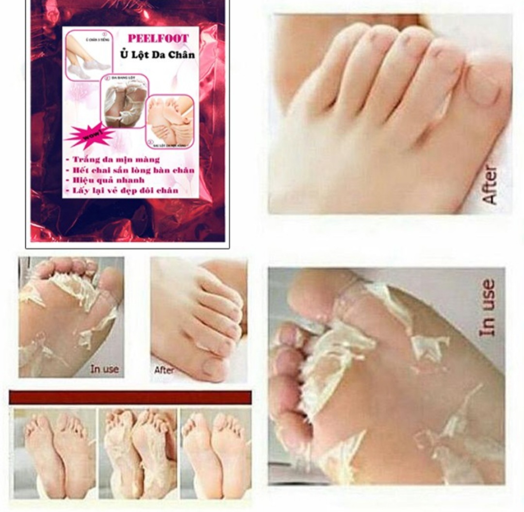 Ủ Lột Da Chân Trắng Mịn Hết Chai Sần nhám