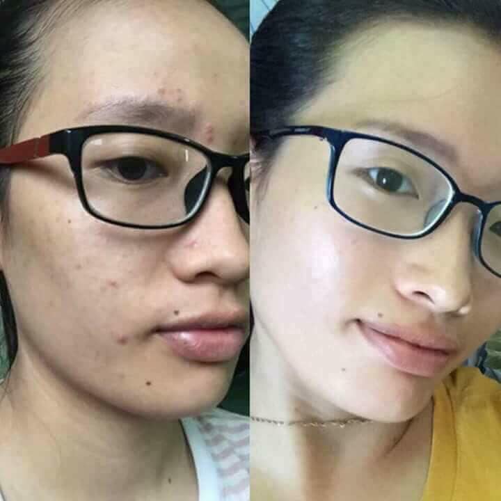 Kem Ngăn Ngừa Mụn Acne