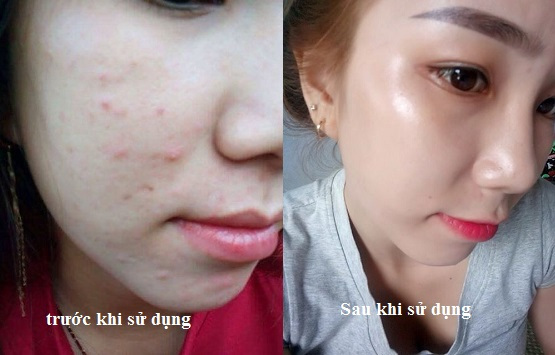 [HCM]Tái Tạo Da Hết Mụn Hết Nám Sạm Trắng Hồng