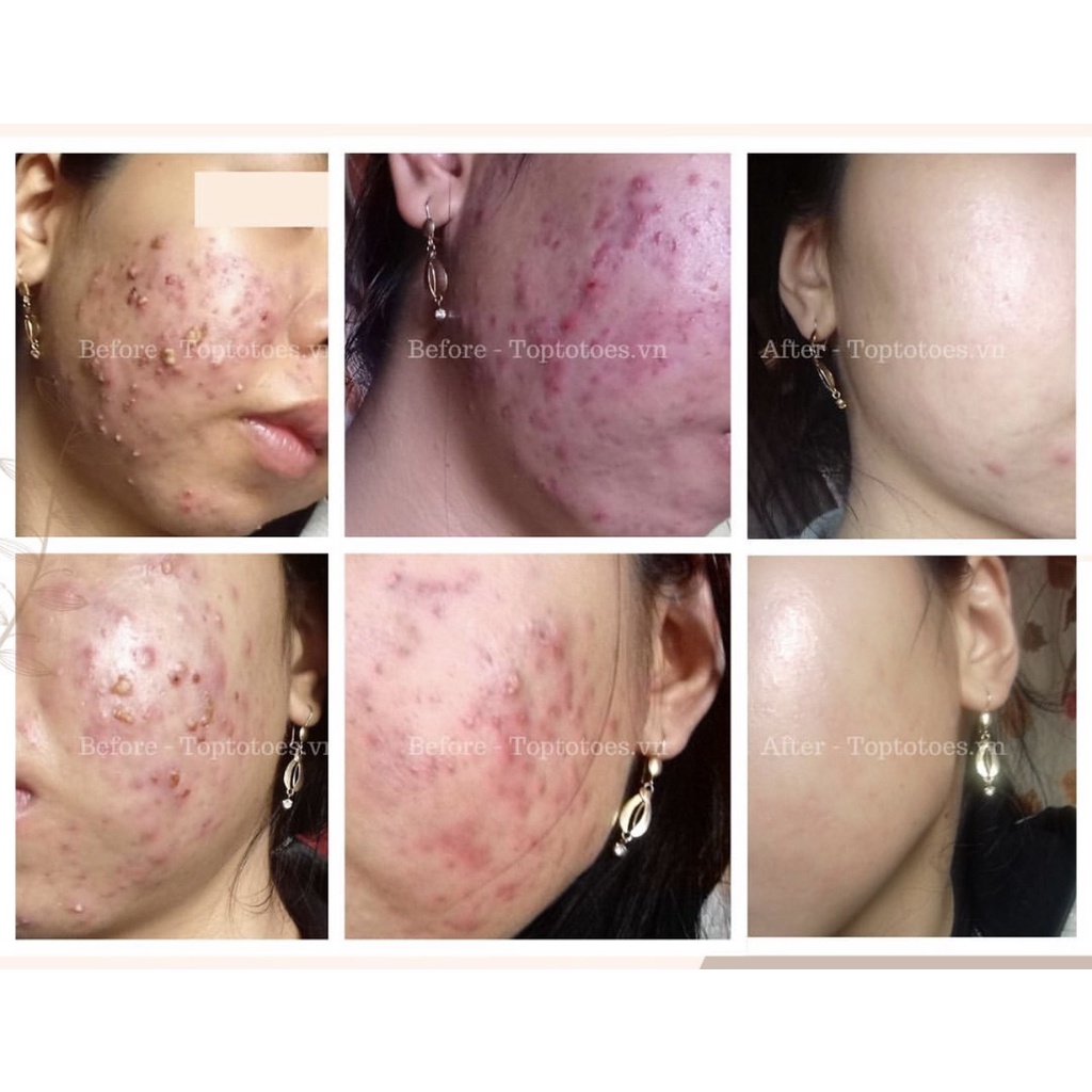Serum Teana Anti-redness & No Problem cho da mụn