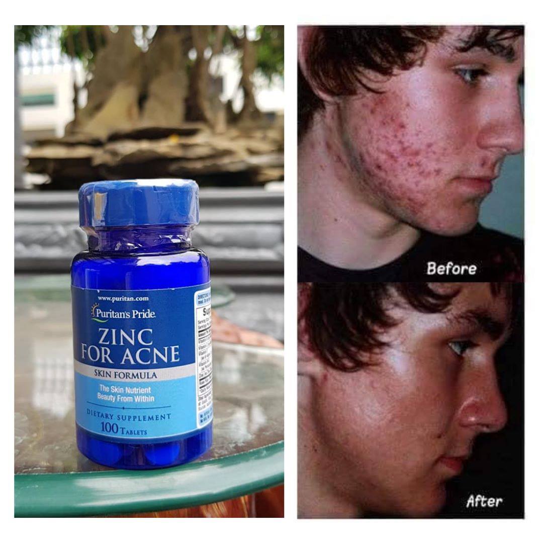 Puritan's Pride Zinc for Acne 100 viên