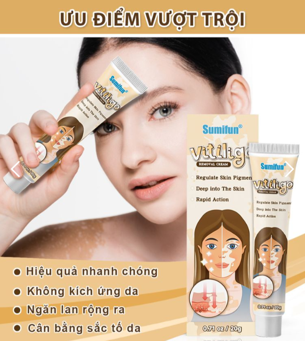 Kem lang ben thảo mộc VITILIGO