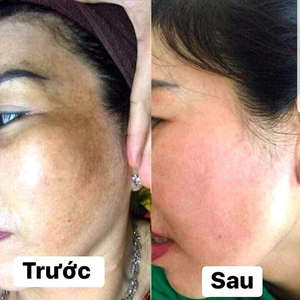 [Chính hãng] Kem Q2 COLLAGEN Nám - Tàn nhang