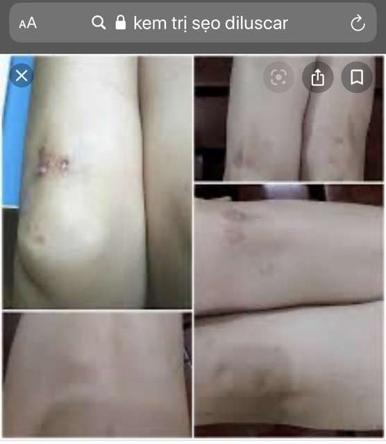 Kem ngừa sẹo Diluscar liền sẹo, mờ sẹo,...