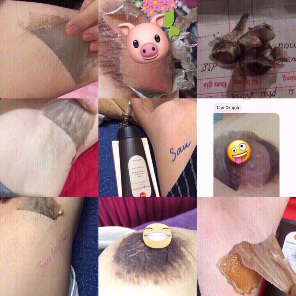 Cao hút thâm  nách, bẹn, nhũ hoa, bikini