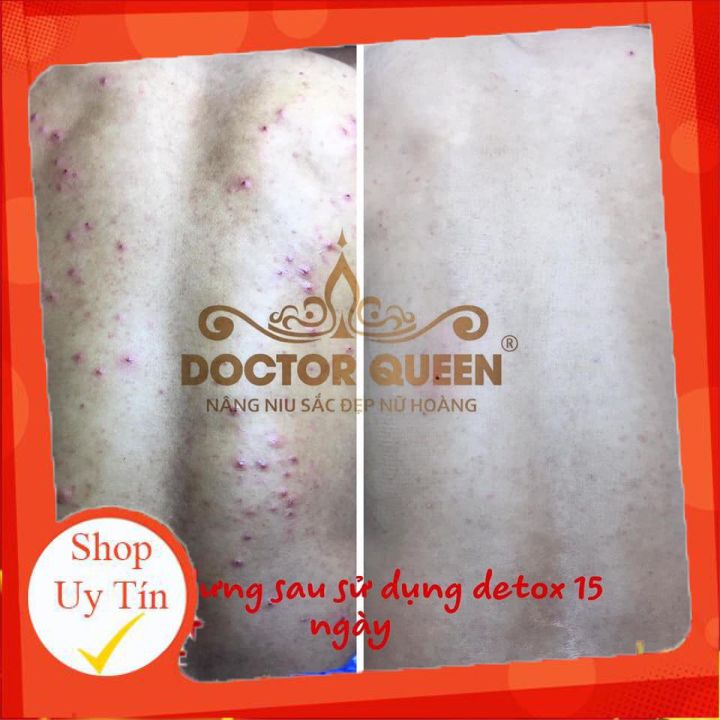 Serum Detox Mụn Doctor Queen 🔥𝐍𝐄𝐖🔥 (Ngừa Tất Cả Các Loại Mụn,Thâm,Đào Thải Phục Hồi Tái Tạo Da,Da Yếu, Giãn Mao Mạch)