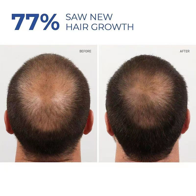 Dầu thầu dầu mọc tóc Minoxidil hosoku 15