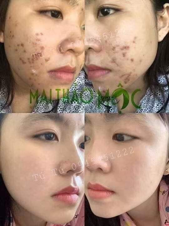 TÁI TẠO CAO CẤP YODY TOMORROW GENTLE PEEL MẪU MỚI 2026