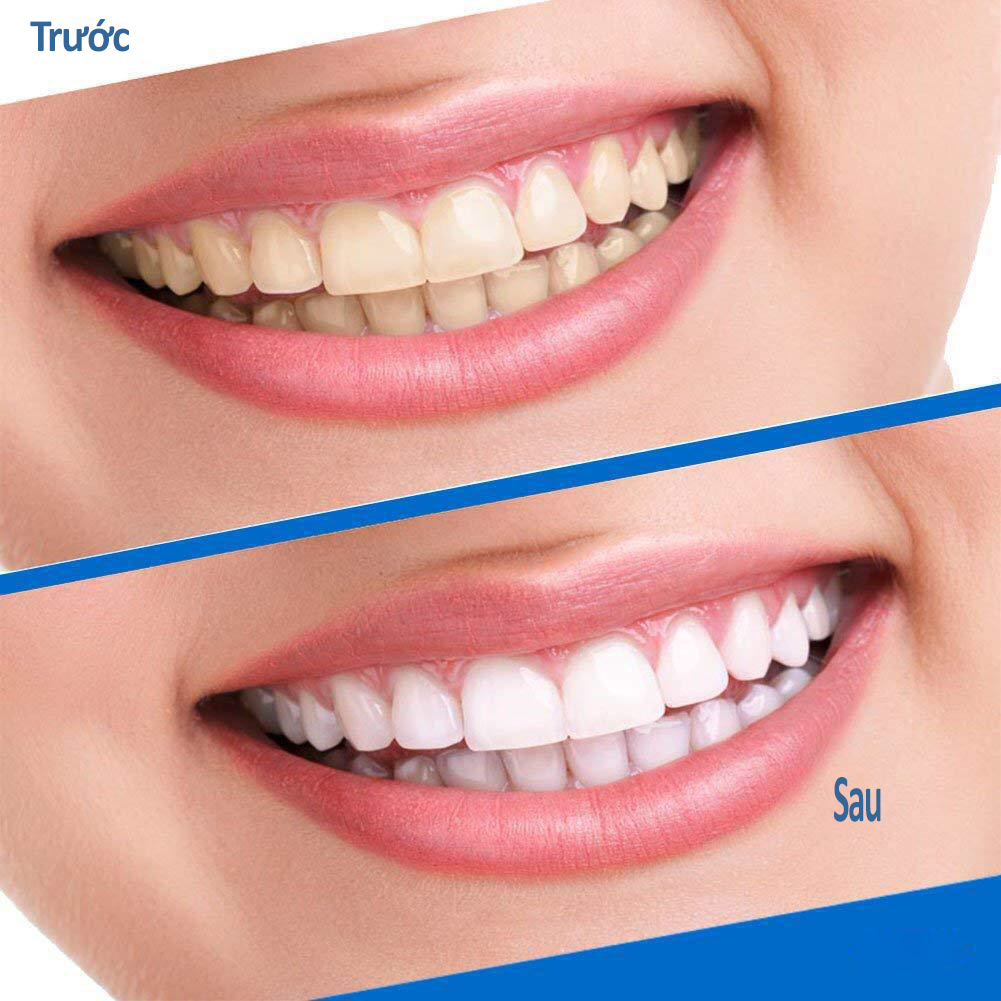 Set 7 Miếng dán trắng răng 5D White Teeth Whitening Strips