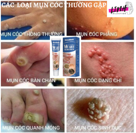 {ĐÁNH BẬT} Mụn Cóc, Mụn Thịt Remove Every Warts
