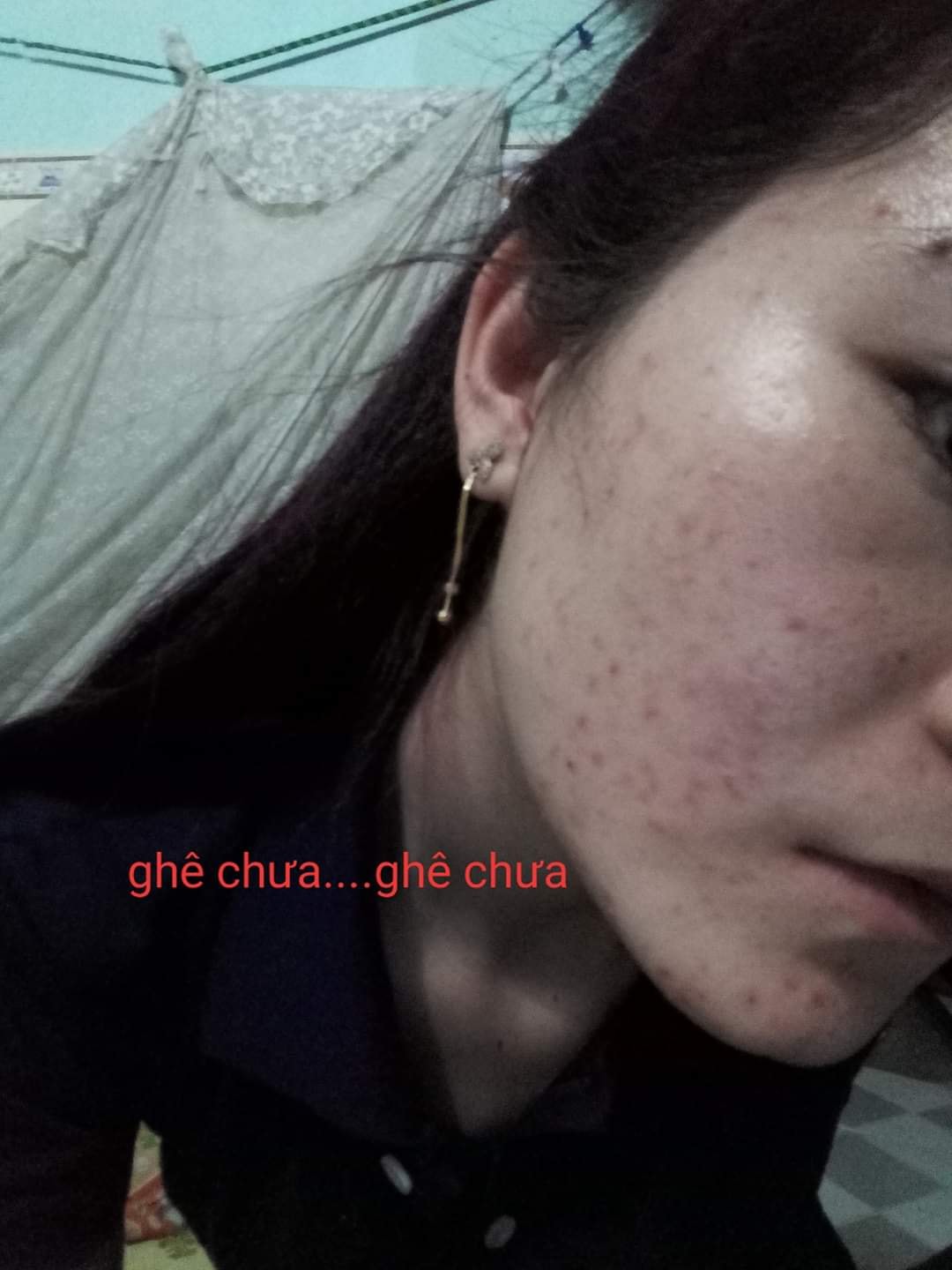 [TẶNG BALO TRÁI TIM]-THẢO DƯỢC TÁI TẠO DA PHƯƠNG ANH