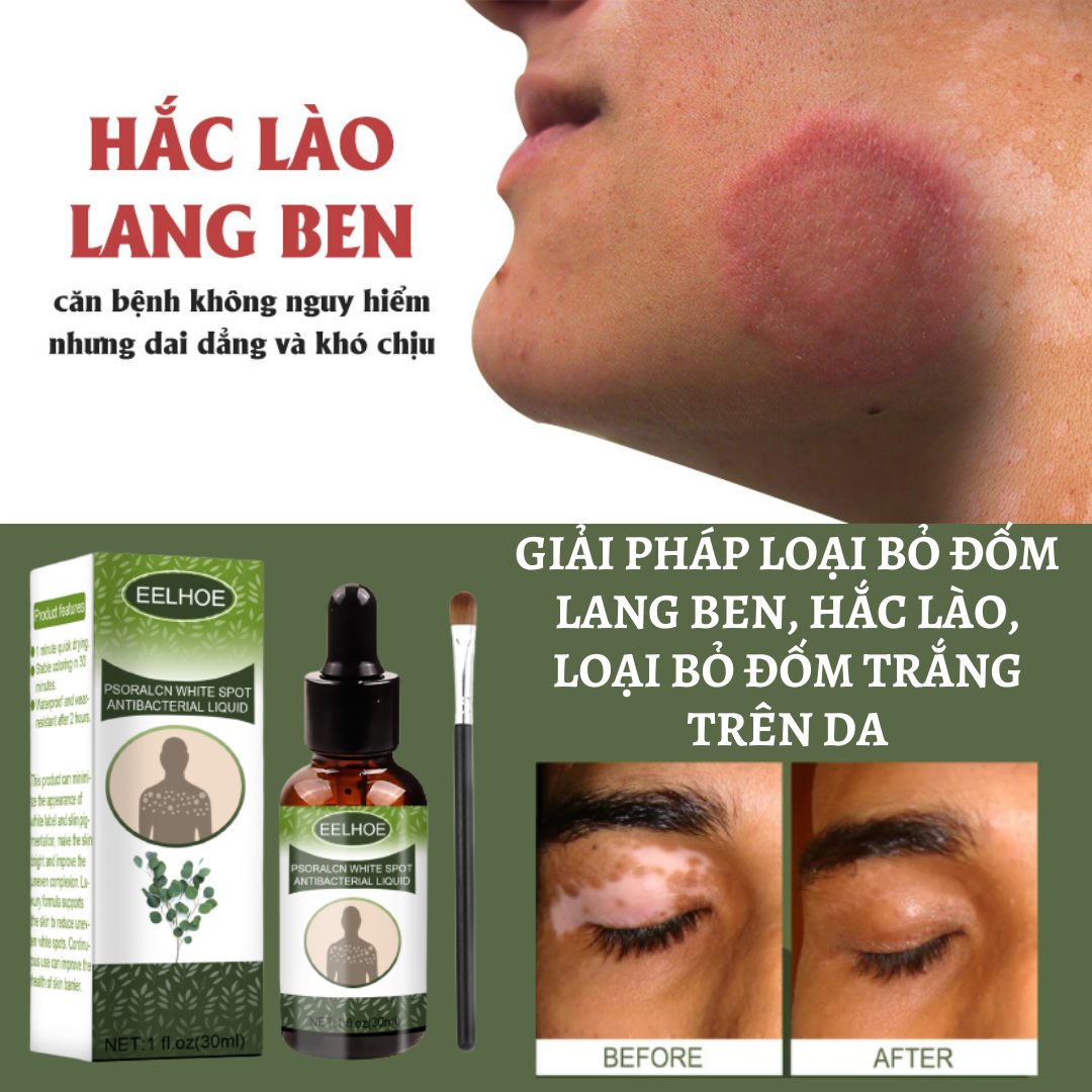 Tinh chất loại bỏ dứt điểm lang ben nấm ngứa xóa sạch đốm trắng trên da giúp da đều màu tạo lớp hàng rào bảo vệ da khỏe mạnh dưỡng ẩm điều chỉnh sắc tố chăm sóc sức khỏe da