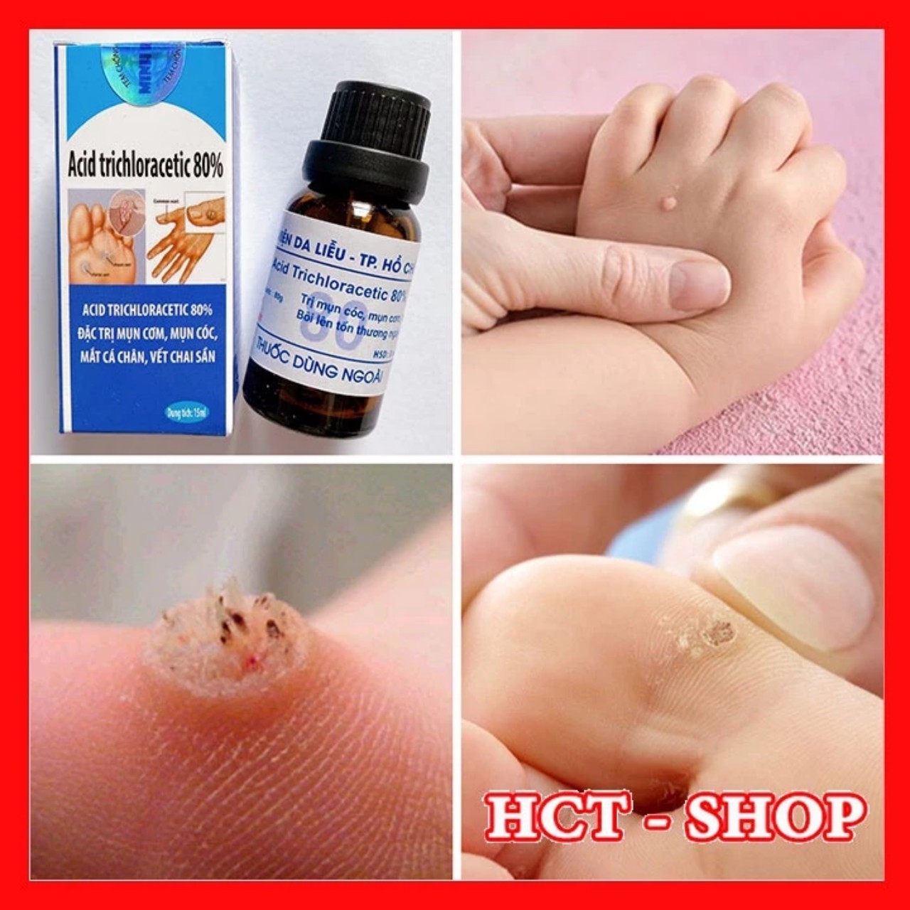 lọ tẩy mụn cóc, mụn cơm, nốt ruồi, mắt cá, mụn thịt cực hiệu quả