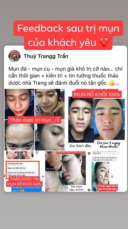 Thảo dược MT sạch mụn thâm rỗ (50Ml)