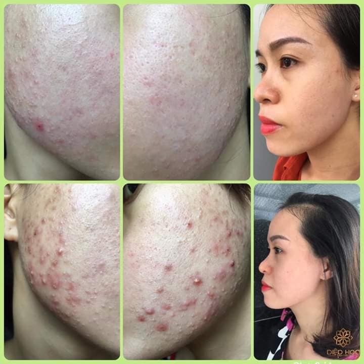 [HCM]SERUM OGANA TRỊ MỤN