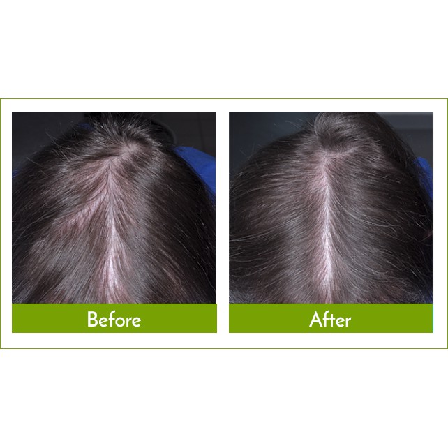 [HCM]Dung Dịch Mọc Tóc Minoxidil 5% Womens  Dạng Bọt Dành Cho Nữ Hãng Rogaine
