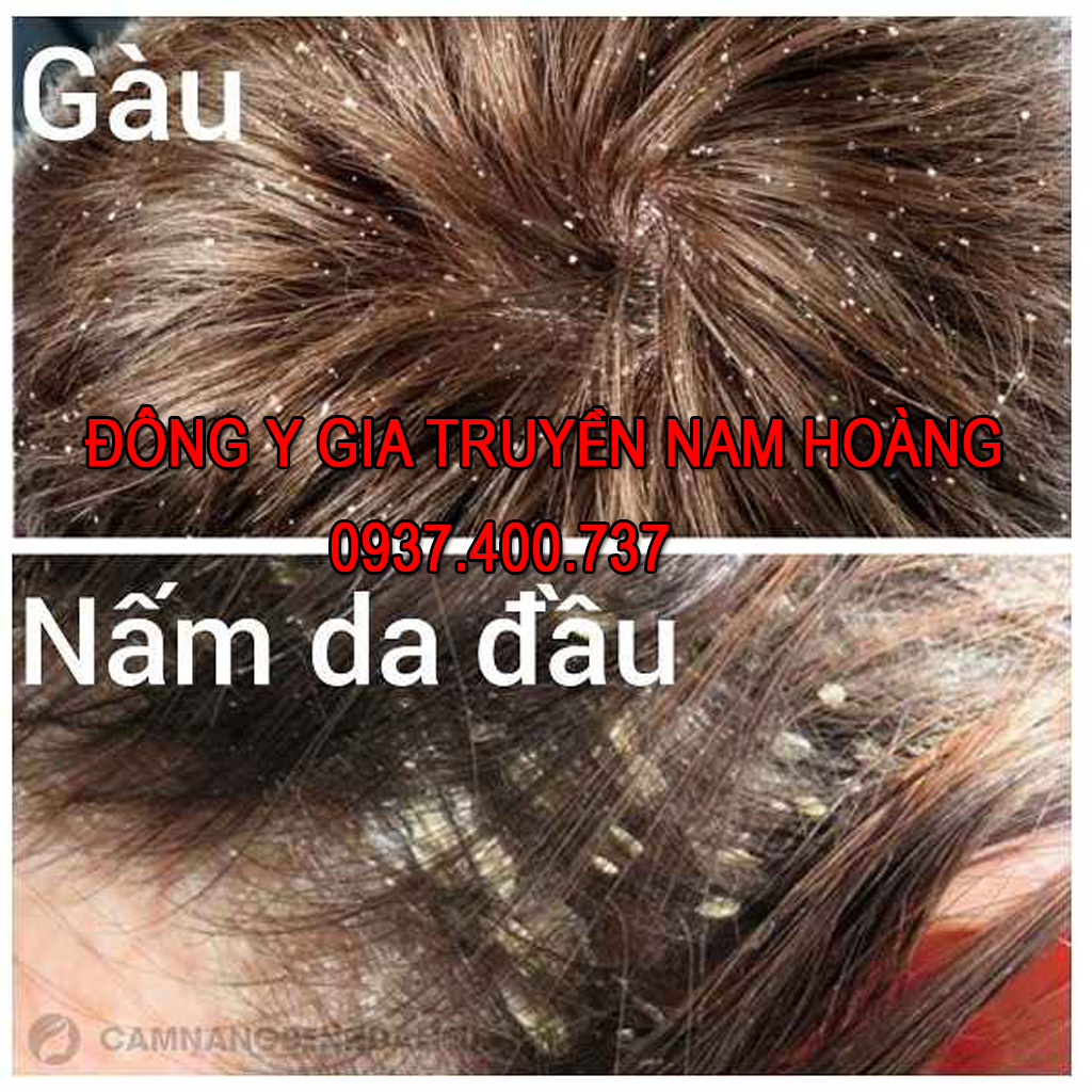 Dược Phẩm Trị Bệnh Nấm Da Đầu Nam Hoàng