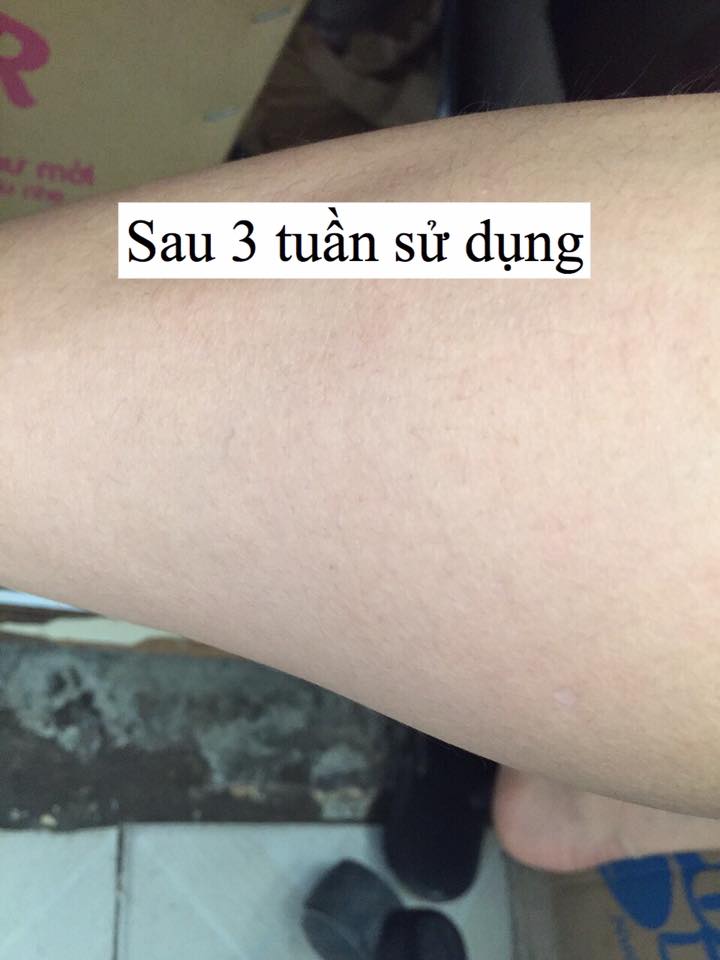 Kem làm mờ sẹo ORO M OZONATED OLIVE OIL Hàn Quốc