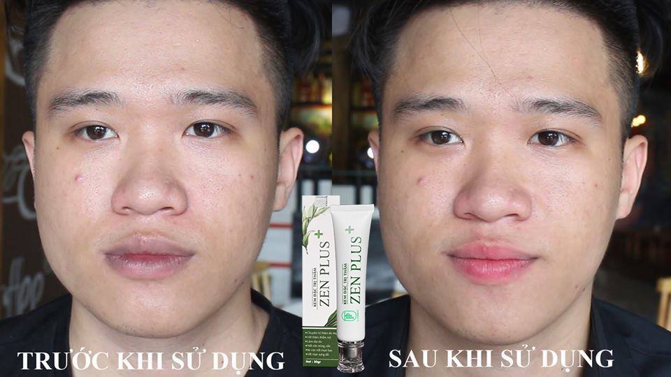 Kem Ngừa Thâm Nám Zen Plus+