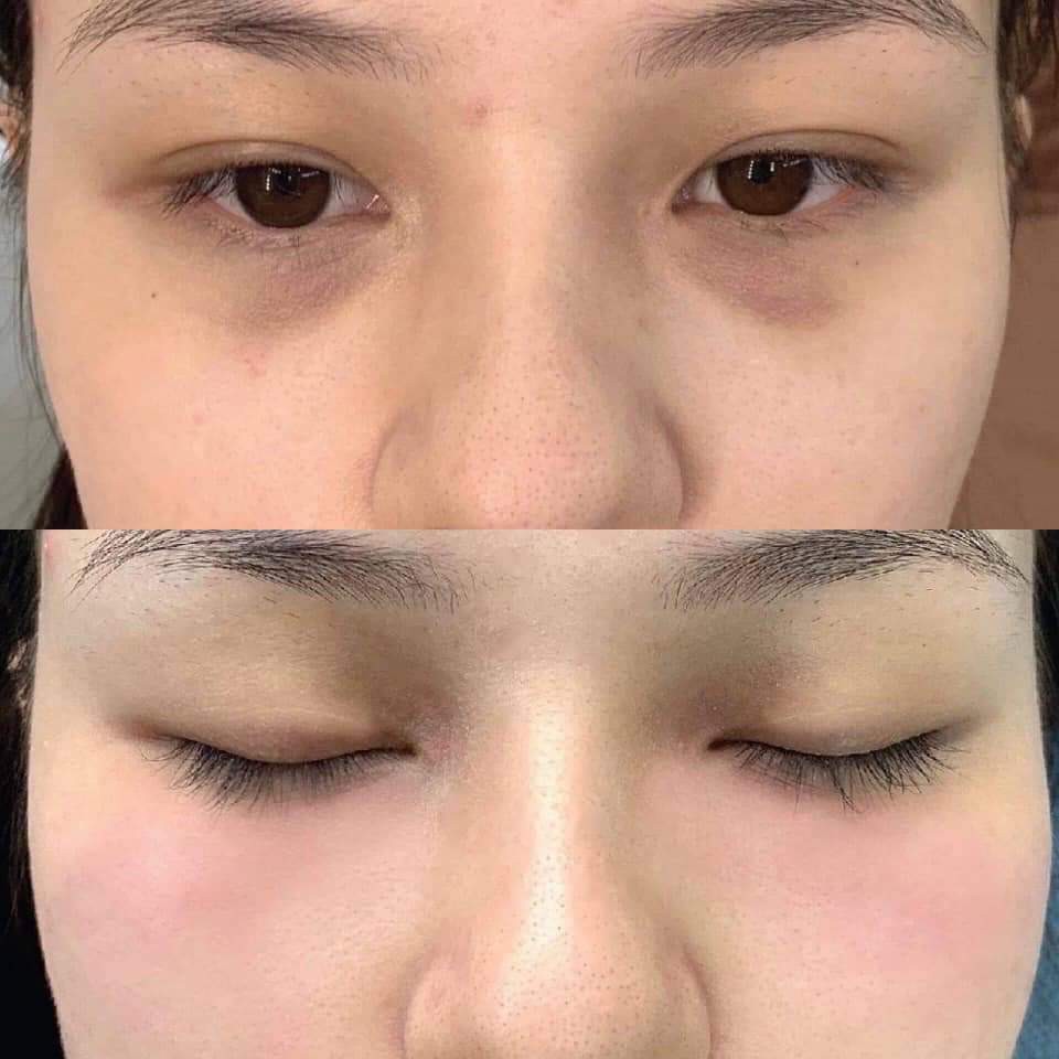 Tan Quầng Thâm Mắt Teoxane 1 - 1 hộp 2cc - Filler Mắt