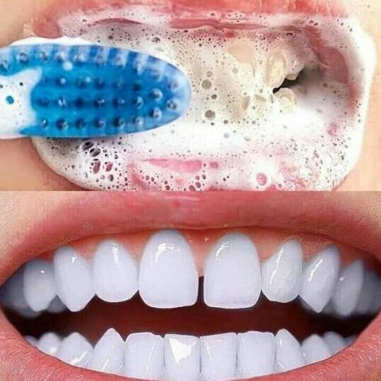 KEM TẨY TRẮNG RĂNG