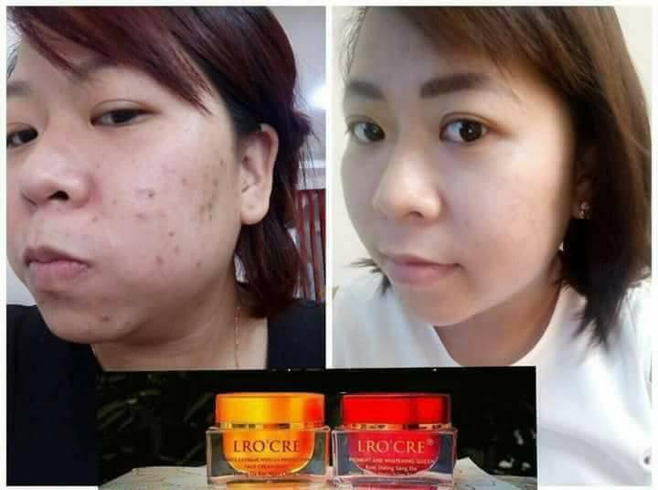 [HCM]Bộ Đôi Kem Nám Tàn Nhang Dưỡng Trắng