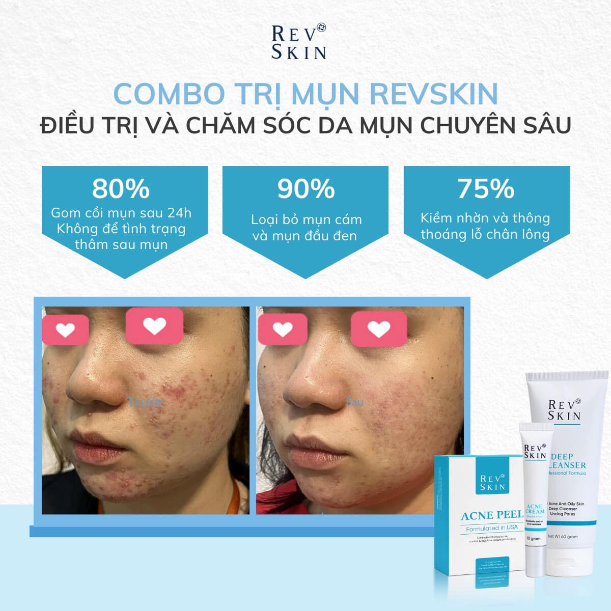 Bộ Peel Mụn- Acne Peel