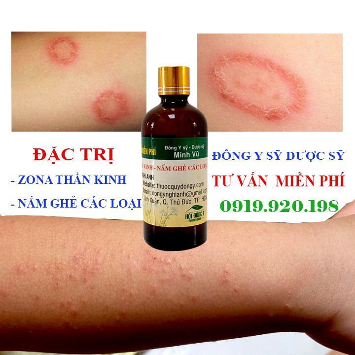 Zona thần kinh bằng thảo mộc - 01 chai